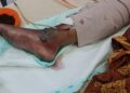 Pemuda Lubuk Linggau Jadi Korban Tabrak Lari, Kaki Harus Diamputasi