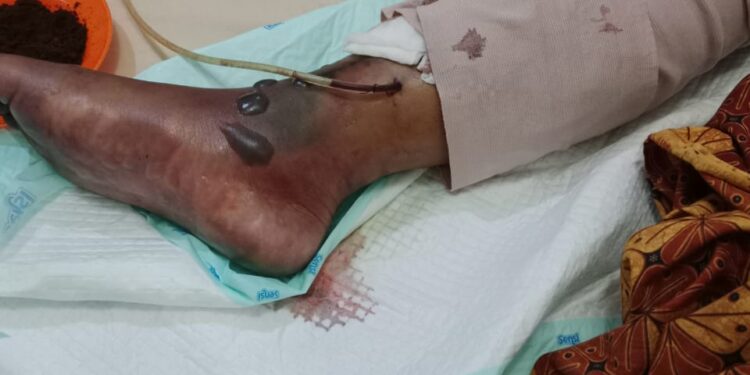 Pemuda Lubuk Linggau Jadi Korban Tabrak Lari, Kaki Harus Diamputasi